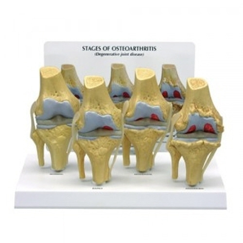 [MD] 무릎관절염4단계(G110)/4단계 표시모형/인체모형/인체해부모형/인체해부도/-CU메디칼